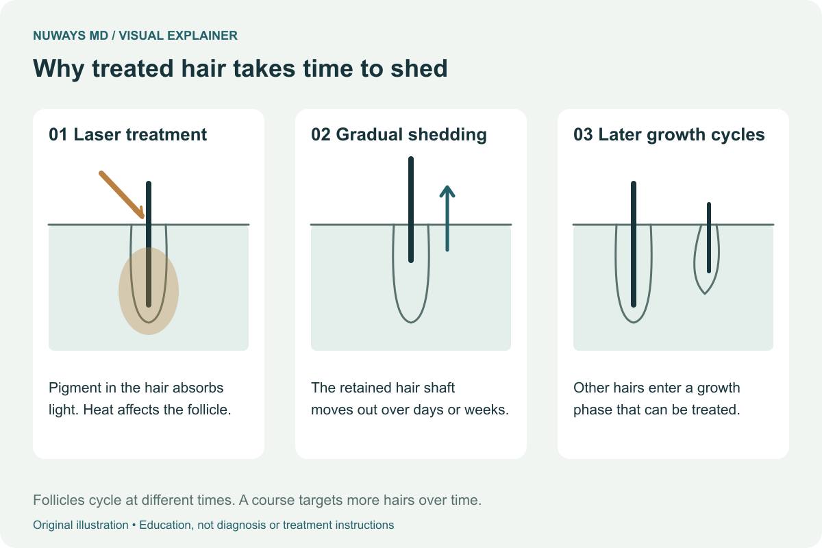 Three stages show laser energy reaching a pigmented hair, a retained hair shaft moving out of the skin, and hairs in different growth phases requiring later visits.